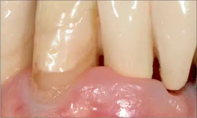 Fig 12i Twentyfive years after implant placement The situation is still - фото 120