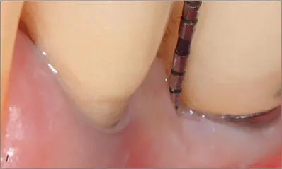 Figs 8kl Tenyear followup Minor pigmentation of the ceramic crown on the - фото 83