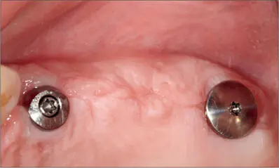 Fig 4i Optimal adaptation of the soft tissues around both implants six weeks - фото 37