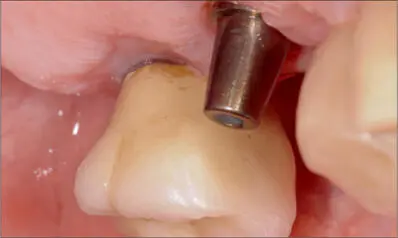 Fig 11d Early healing six weeks after surgery Fig 11e Palatal view of implant - фото 109