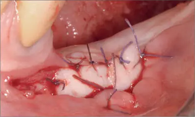 Fig 9f Free gingival graft sutured on the periosteum after elevating a - фото 89