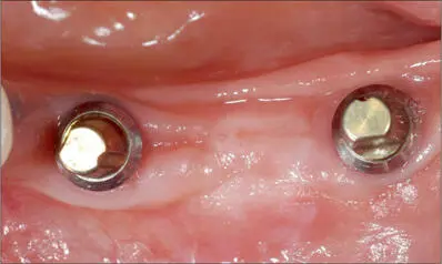Fig 8g At the time of delivery of the final prosthesis occlusal view Fig 8h - фото 78