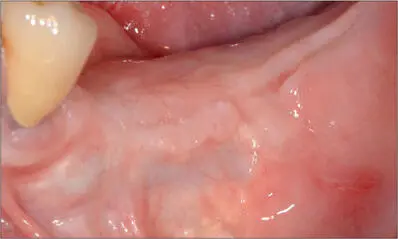 Fig 9k Clinical view six months after regeneration surgery Optimal healing - фото 94