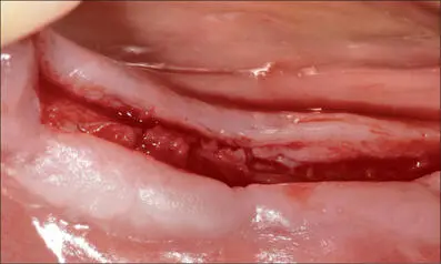 Fig 8c Three months after softtissue augmentation A thick band of keratinized - фото 74