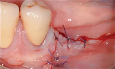 Figs 9ac Surgical removal of the fractured implant Figs - фото 86