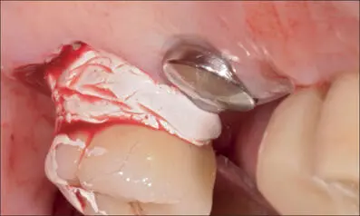 Fig 11c Application of a periodontal dressing Fig 11d Early healing six weeks - фото 108