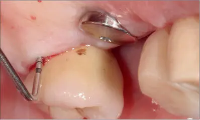 Fig 11a Implant 27 placed nine years previously palatal view 13mm pocket - фото 106
