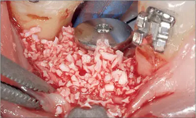 Fig 6bc Once the implant was placed S SLA diameter 41 mm length 12 mm - фото 55