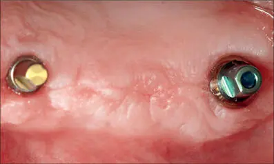 Fig 4j Solid abutments 4 mm in height connected eight weeks after implant - фото 38