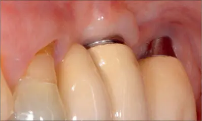 Fig 10f Nine years after the surgical correction Plaque control was improved - фото 105