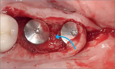 Fig 5e The pedicle flap was rotated counterclockwise Fig 5f Pedicle inserted - фото 46