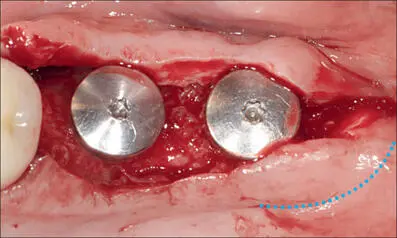 Fig 5d Incision on the distal portion of the palatal flap Fig 5e The pedicle - фото 45