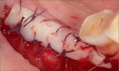 Fig 7d Free gingival graft harvested from the palate sutured above a - фото 66