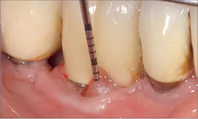Fig 13a Mucositis around an implant SLA S diameter 41 mm length 8 mm - фото 121