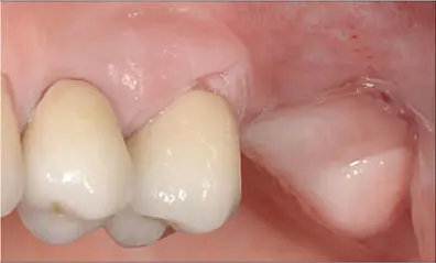 Fig 5a Preoperative situation Fig 5b Incision placed slightly palatally to - фото 42