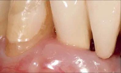 Fig 12g Sevenyear followup No signs of inflammation The softtissue - фото 118