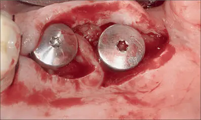 Fig 5f Pedicle inserted between the two implants Fig 5g The pedicle was - фото 47