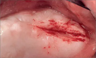Fig 4d Left posterior maxilla after removal of the excess tissue which was - фото 32