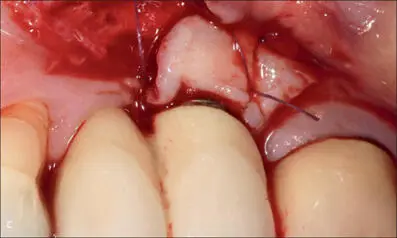Fig 10ce A trapezoidal splitthickness flap was elevated at the - фото 102