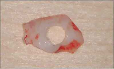 Fig 13d An FGG was harvested from the palate and perforated with a 4mm biopsy - фото 124