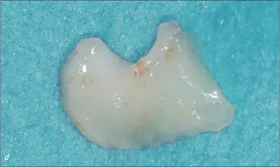 Fig 10ce A trapezoidal splitthickness flap was elevated at the implant site - фото 103