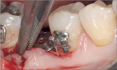 Fig 6ef The mesial papilla rotated 90 counterclockwise and sutured to the - фото 58