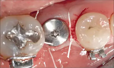 Fig 6gh ePTFE sutures buccal and occlusal views Fig 6i Early healing at - фото 60