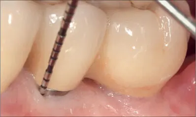 Fig 9p Six months after implant placement the probe indicated a shallow sulcus - фото 99