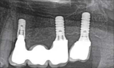 Fig 11f Panoramic radiograph Ideal periimplant bone levels around the distal - фото 111