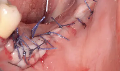 Fig 9i Flap closed without tension despite coronal advancement and adapted to - фото 92