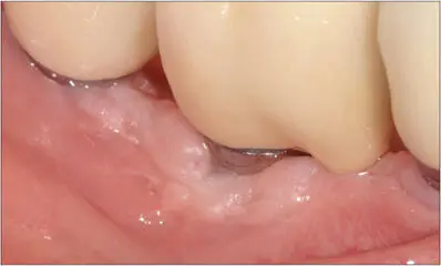 Fig 13h New screwretained ceramic crown in situ Dentists should focus on more - фото 128