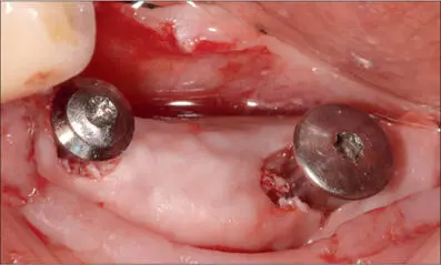 Fig 8e Guided bone regeneration with autologous bone in contact with the - фото 76