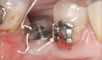 Fig 6gh ePTFE sutures buccal and occlusal views Fig 6 - фото 59