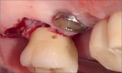 Fig 11b Gingivectomy to eliminate the excessive soft tissue Fig 11c - фото 107