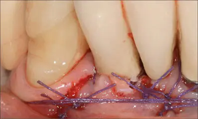 Fig 12f Flap sutured with 40 Vicryl to completely cover the connectivetissue - фото 117