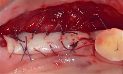 Fig 7e Graft sutured with 40 Vicryl occlusal view Fig 7f At three months a - фото 67