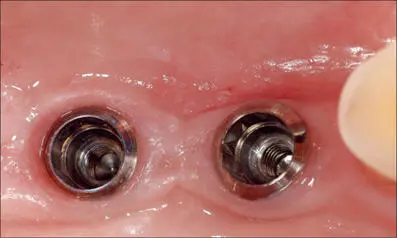 Fig 7g At the time of the final impression occlusal view Both implants are - фото 69