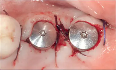 Fig 5h Final suture distally to the distal implant Fig 5i Preoperative - фото 49