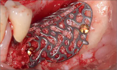 Fig 9h Custommade Timesh filled with autologous bone combined with DBBM and - фото 91
