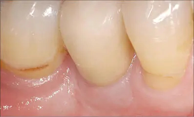 Fig 6j Fifteen months after implant placement facial view Ideal contour of - фото 62