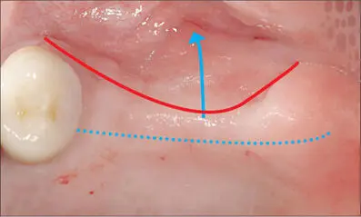 Fig 5b Incision placed slightly palatally to move keratinized tissue onto the - фото 43