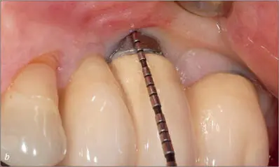 Fig 10ab Radiographic and clinical view of two implants SLA S diameter 41 - фото 101