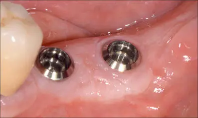 Fig 9o Three months after surgery Implants surrounded by a thick cuff of - фото 98