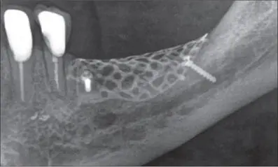 Figs 9l Radiographic view of the augmented area before implant placement - фото 95