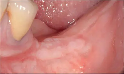 Fig 9g Four months after softtissue augmentation lateral view Fig 9h - фото 90