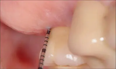 Fig 11e Palatal view of implant 27 presenting with 3mm probing depth and no - фото 110
