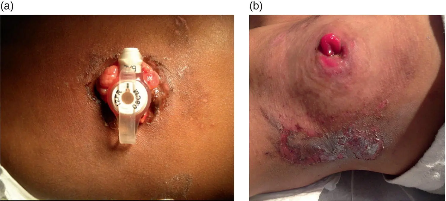 Figure 14 a Granuloma notable for its pearly color and irregular shape b - фото 5