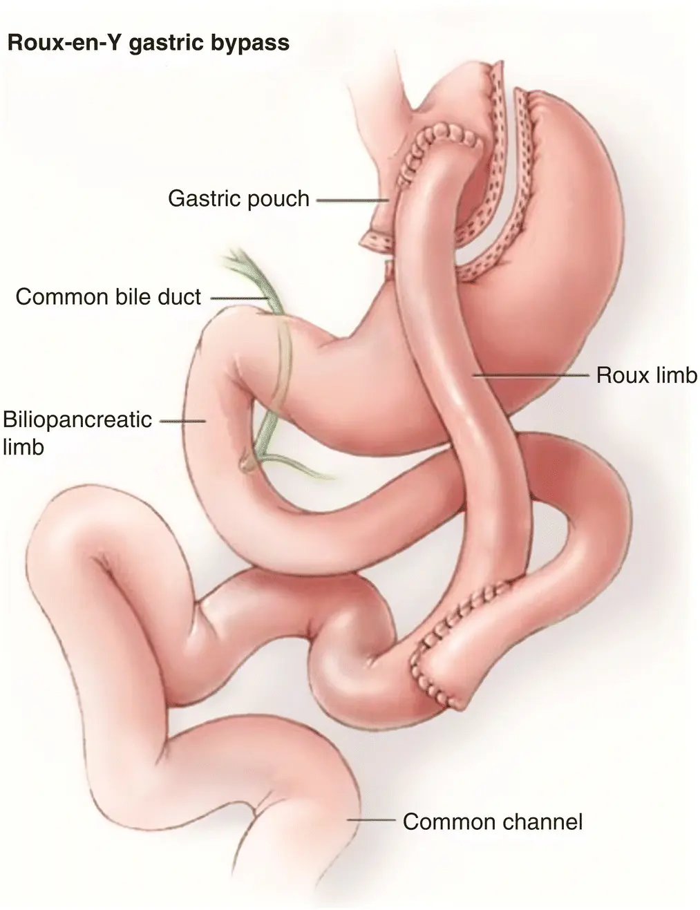 Figure 31 Pencil drawing of RYGB Source Penn Medicine In the RYGB a small - фото 9