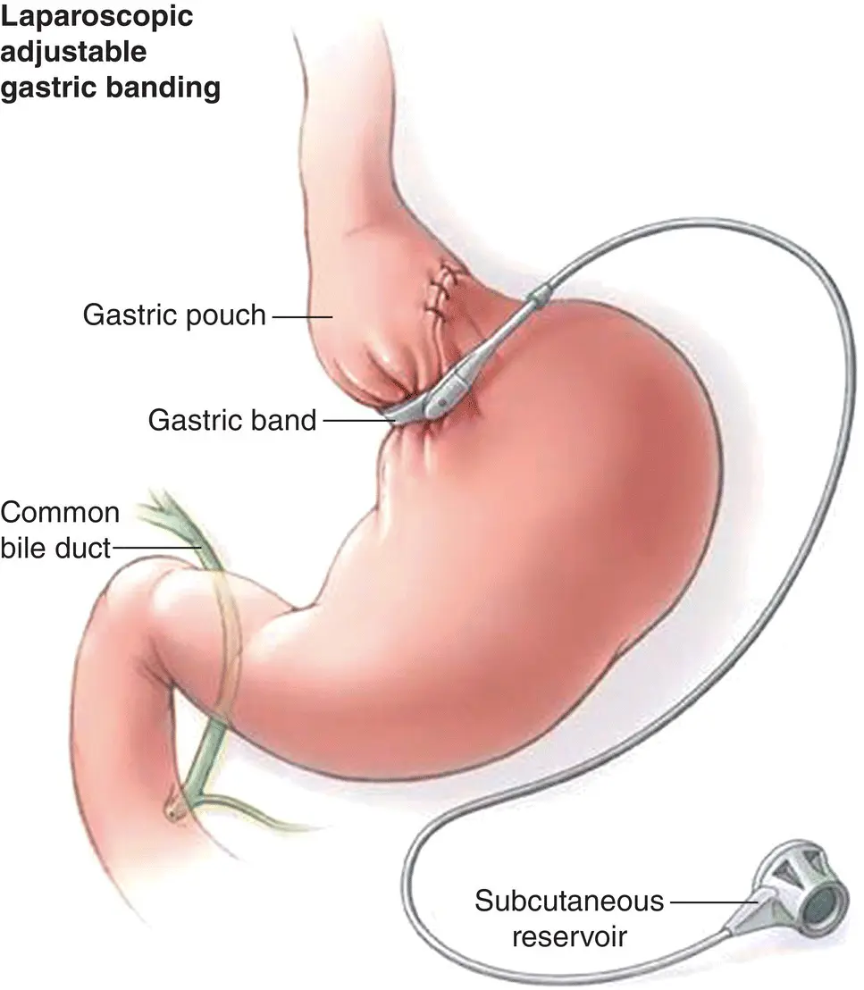 Figure 32Pencil drawing of LAGB Source Swedish Health Services Figure 33 - фото 10