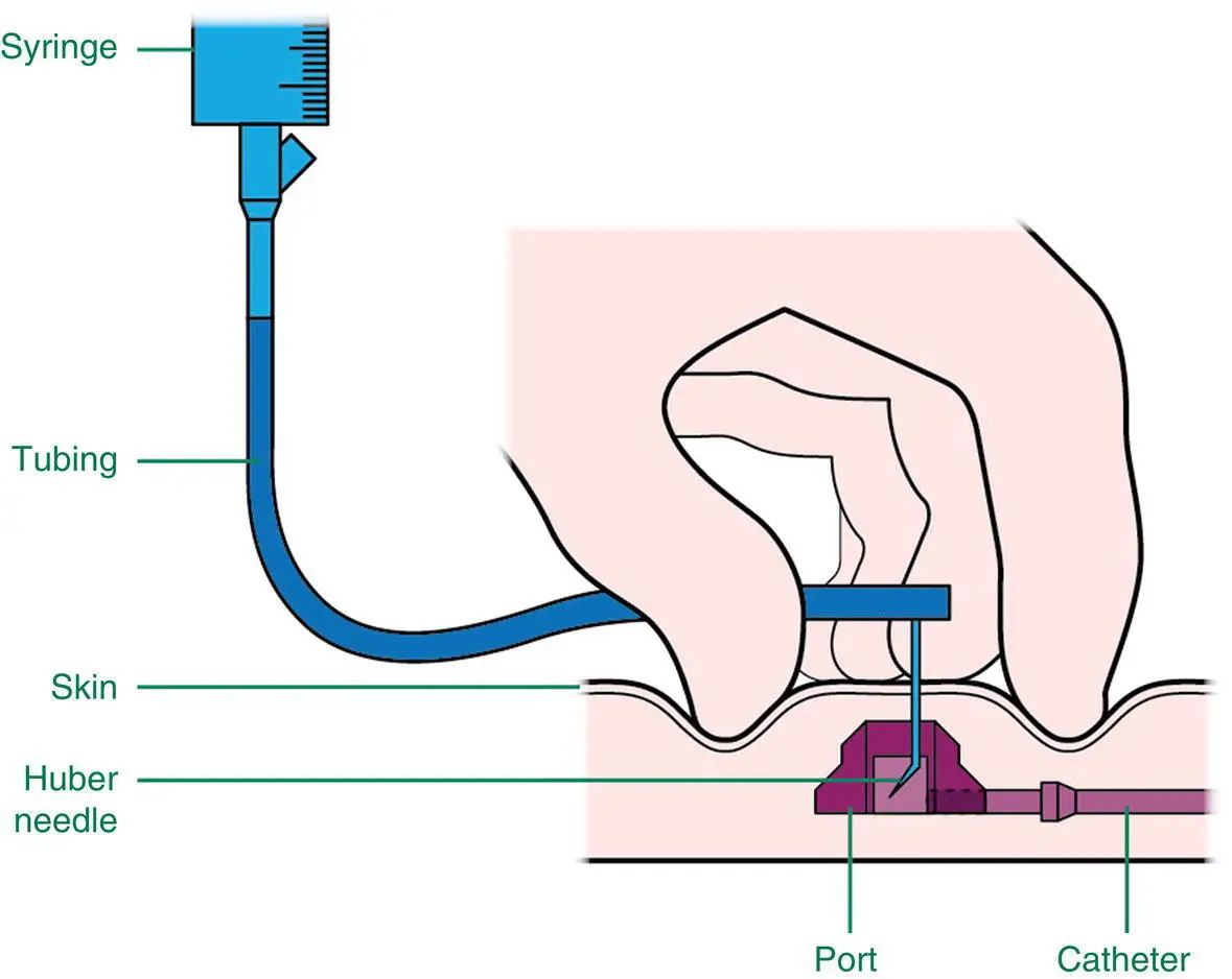 Figure 53 Schematic of fully implanted CVC Source Image courtesy of - фото 15